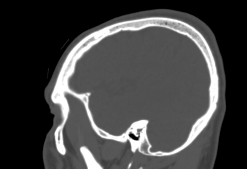 Asymptomatic occipital spur (Radiopaedia 87753-104201 Sagittal bone window 248).jpg