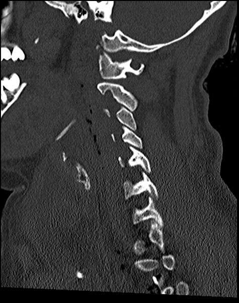 File:Atlanto-occipital dissociation - Traynelis type 1 (Radiopaedia 87570-103948 Sagittal bone window 55).jpg