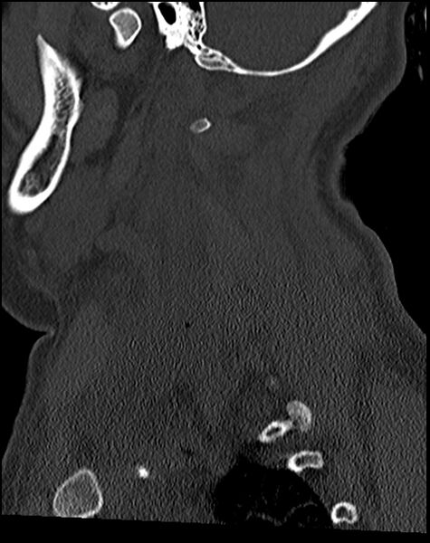 File:Atlanto-occipital dissociation - Traynelis type 1 (Radiopaedia 87570-103948 Sagittal bone window 63).jpg