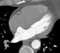 Atrial septal aneurysm (Radiopaedia 31500).jpg