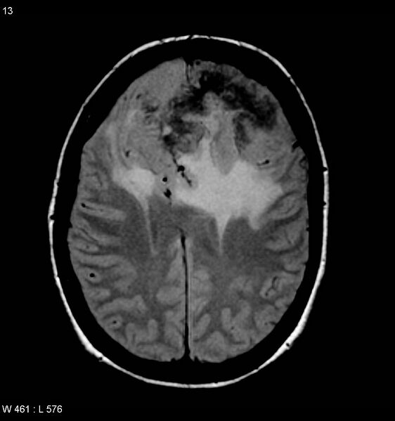 File:Atypical meningioma (WHO grade II) (Radiopaedia 7762-8586 Axial FLAIR 3).jpg