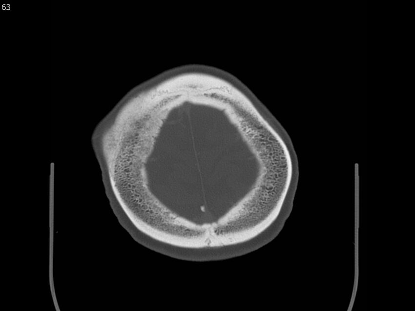 Atypical meningioma - intraosseous (Radiopaedia 64915-73867 Axial C+ bone window 63).jpg