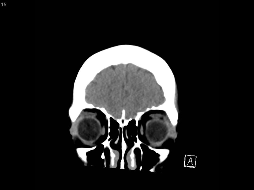 Atypical meningioma - intraosseous (Radiopaedia 64915-73867 B 14).jpg