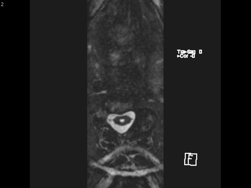 File:Atypical meningioma - intraosseous (Radiopaedia 64915-74572 Axial CISS 2).jpg