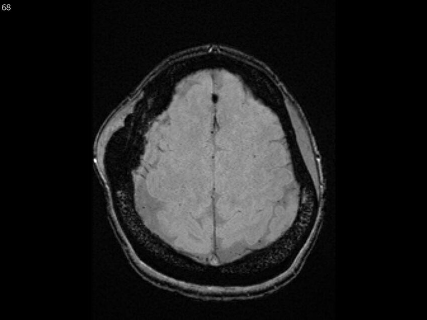 Atypical meningioma - intraosseous (Radiopaedia 64915-74572 Axial SWI 68).jpg