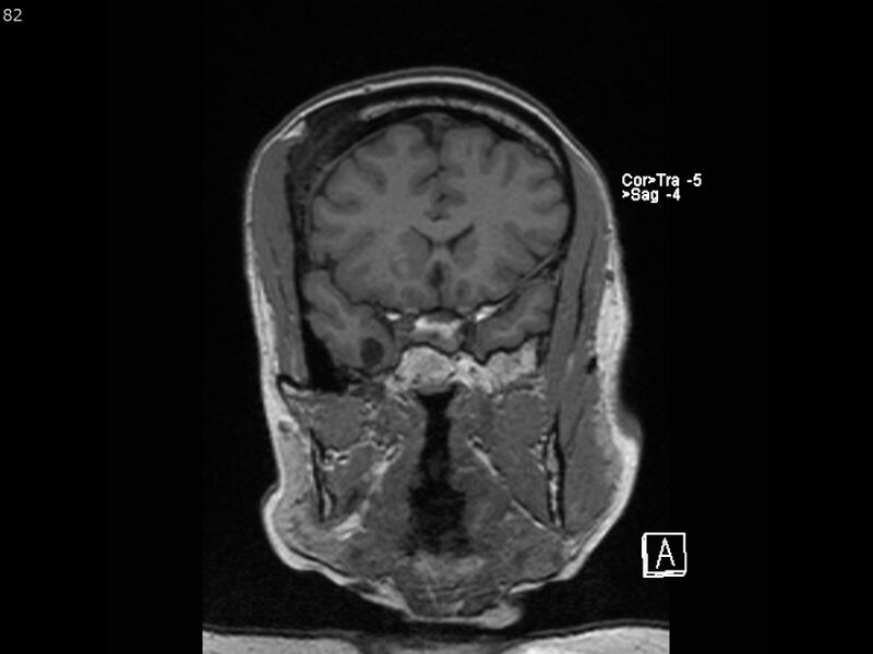 File:Atypical meningioma - intraosseous (Radiopaedia 64915-74572 Coronal T1 82).jpg