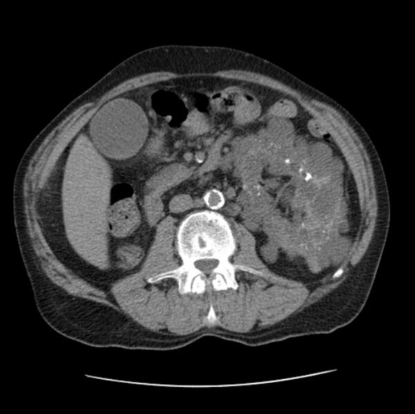 File:Autosomal dominant polycystic kidney disease (Radiopaedia 27851-28094 Axial non-contrast 72).jpg