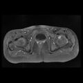 Avascular necrosis of the hip (Radiopaedia 29563-30067 Axial T1 C+ fat sat 10).jpg