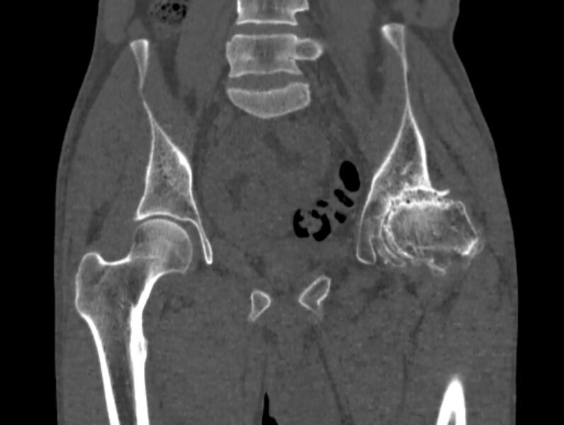 File:Avascular necrosis of the left hip (Radiopaedia 75068-86125 Coronal bone window 30).jpg