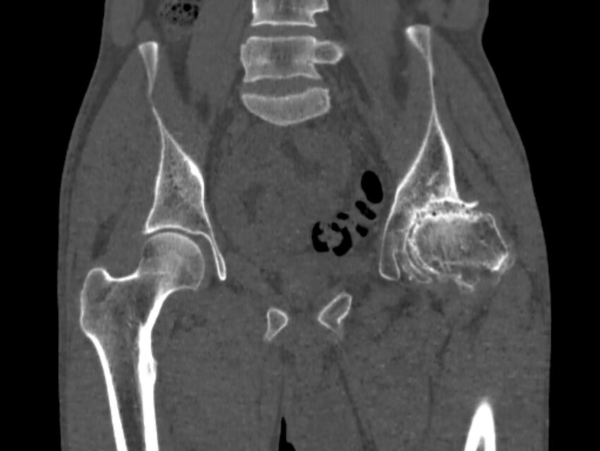Avascular necrosis of the left hip (Radiopaedia 75068-86125 Coronal bone window 30).jpg