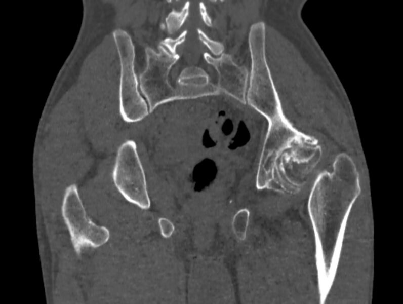 File:Avascular necrosis of the left hip (Radiopaedia 75068-86125 Coronal bone window 62).jpg
