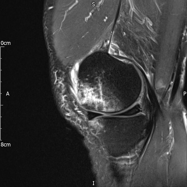 File:Avulsion fracture of the fibular head (Radiopaedia 74804-85808 Sagittal PD fat sat 9).jpg