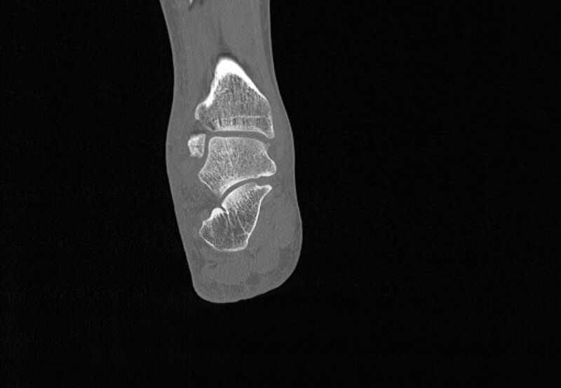 File:Avulsion fractures of talus and calcaneus (Radiopaedia 48277-53155 Coronal bone window 69).jpg