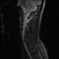 Axis fracture - MRI (Radiopaedia 71925-82375 Sagittal STIR 3).jpg