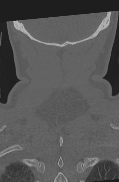 File:Axis peg fracture (type 3) and atlas lateral mass (type 4) fracture (Radiopaedia 37474-39324 Coronal bone window 58).png