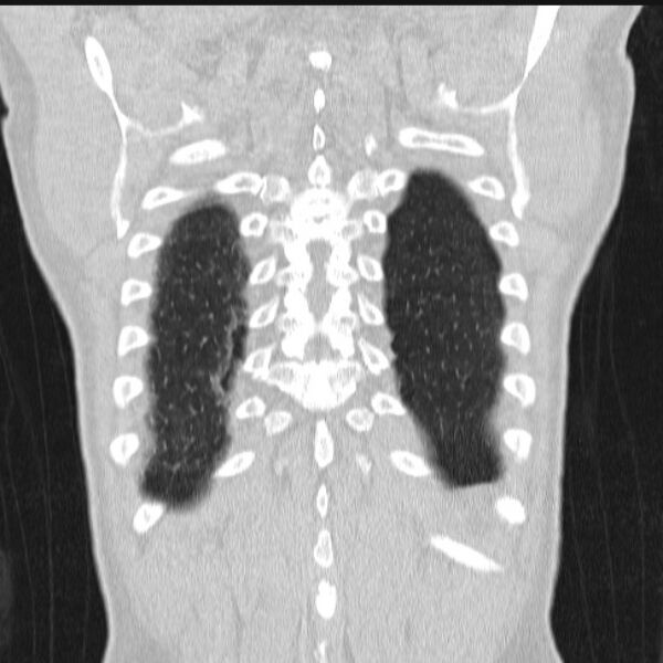 File:Azygos lobe (Radiopaedia 38259-40275 Coronal lung window 69).jpg