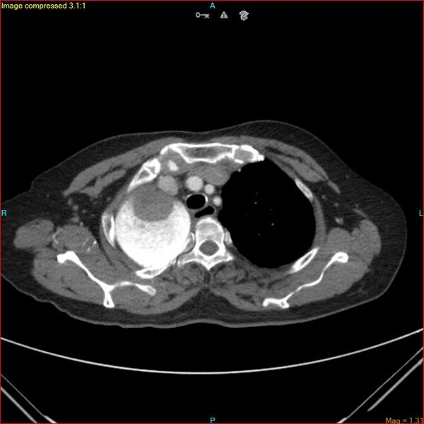 File:Azygos vein aneurysm (Radiopaedia 77824-90130 B 14).jpg