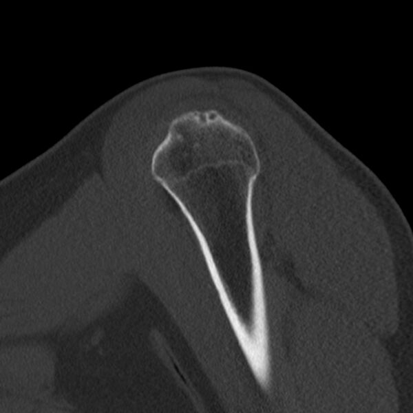 File:Bankart lesion (Radiopaedia 22771-22798 Sagittal bone window 10).jpg