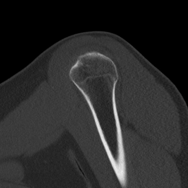 File:Bankart lesion (Radiopaedia 22771-22798 Sagittal bone window 9).jpg