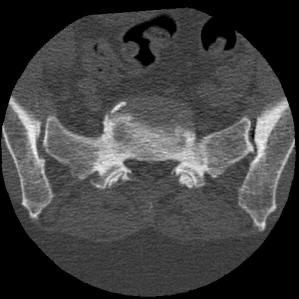 File:Bertolotti syndrome (Radiopaedia 24864-25128 Axial bone window 34).jpg