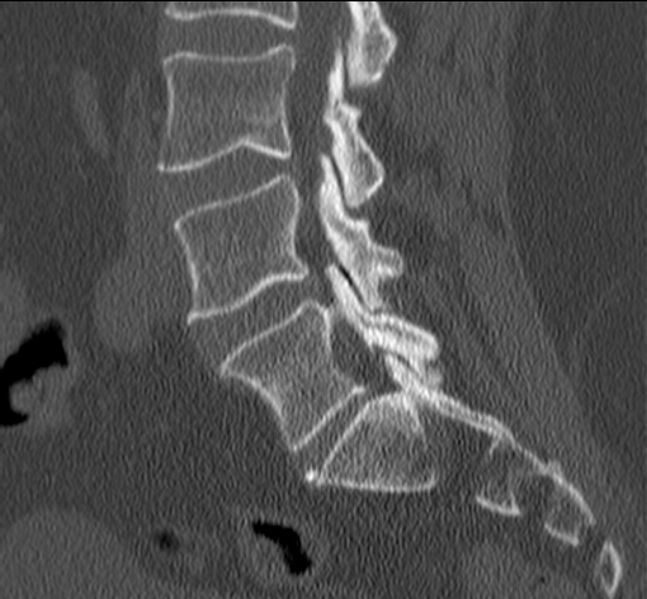File:Bertolotti syndrome (Radiopaedia 24864-25128 Sagittal bone window 23).jpg