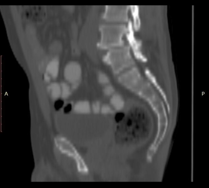 File:Bertolotti syndrome (Radiopaedia 58974-66235 Sagittal bone window 20).jpg