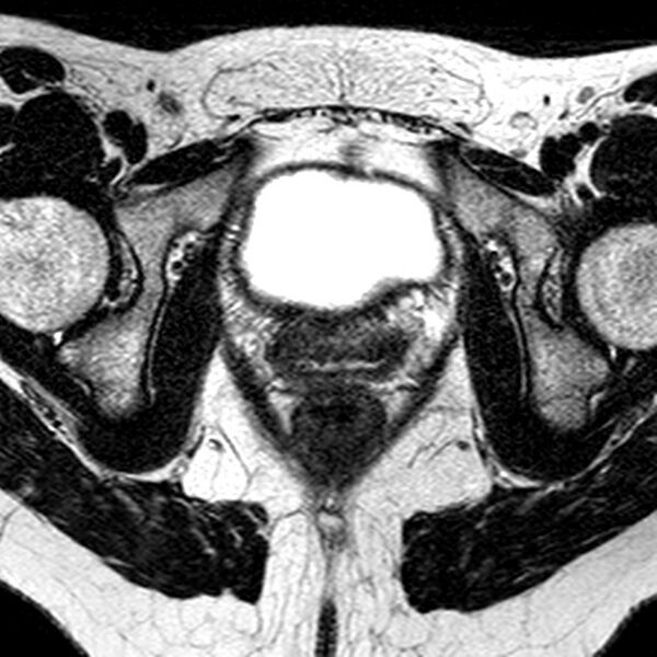 File:Bicornuate uterus (Radiopaedia 11104-11492 Axial T2 10).jpg