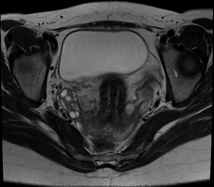 File:Bicornuate uterus (Radiopaedia 71214-81511 Axial T2 16).jpg