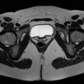 Bicornuate uterus (Radiopaedia 72135-82643 Axial T2 18).jpg
