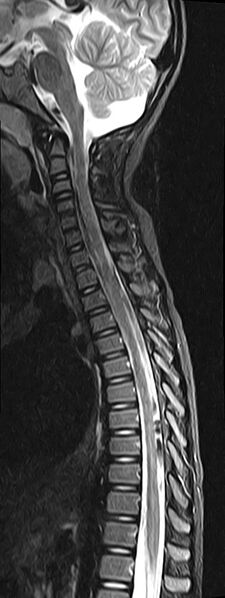 File:Bilateral Sprengel deformity with Klippel-Feil syndrome (Radiopaedia 66395-75650 Sagittal STIR 7).jpg