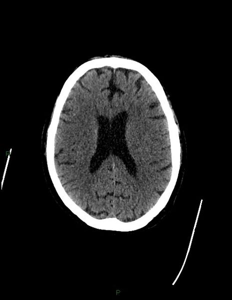 File:Bilateral acute middle cerebral artery territory infarcts (Radiopaedia 77319-89401 Axial non-contrast 54).jpg