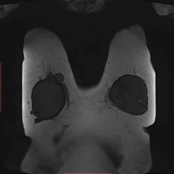 File:Bilateral breast implant rupture (Radiopaedia 24761-25027 G 58).jpg