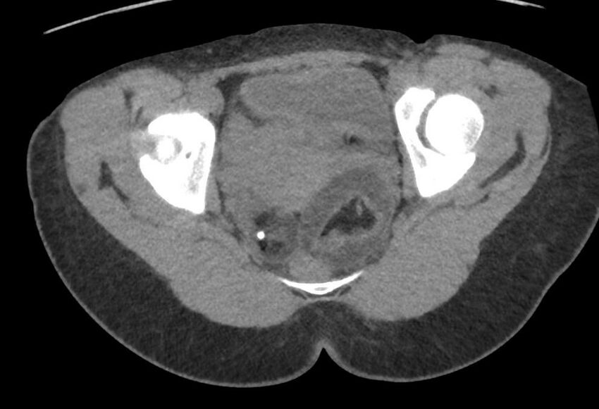Bilateral mature cystic ovarian teratoma (Radiopaedia 88821-105592 Axial non-contrast 36).jpg