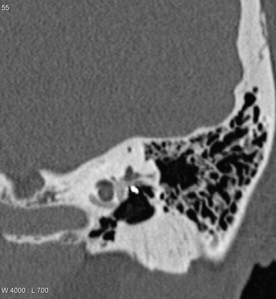 File:Bilateral otosclerosis with left stapes prosthesis (Radiopaedia 5567-7302 D 7).jpg