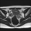 Bilateral ovarian endometriomas (Radiopaedia 87085-103347 Axial T2 10).jpg