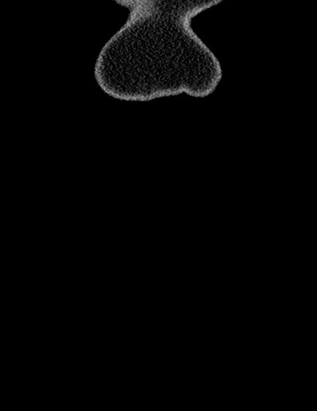 File:Bilateral staghorn calculi (Radiopaedia 59475-66842 Coronal non-contrast 20).jpg