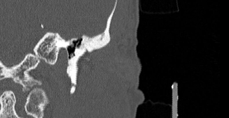 File:Bilateral temporal bone fractures (Radiopaedia 29482-29970 B 6).jpg