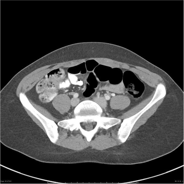 File:Bilateral ureteritis and cystitis (Radiopaedia 25340-25594 A 52).jpg