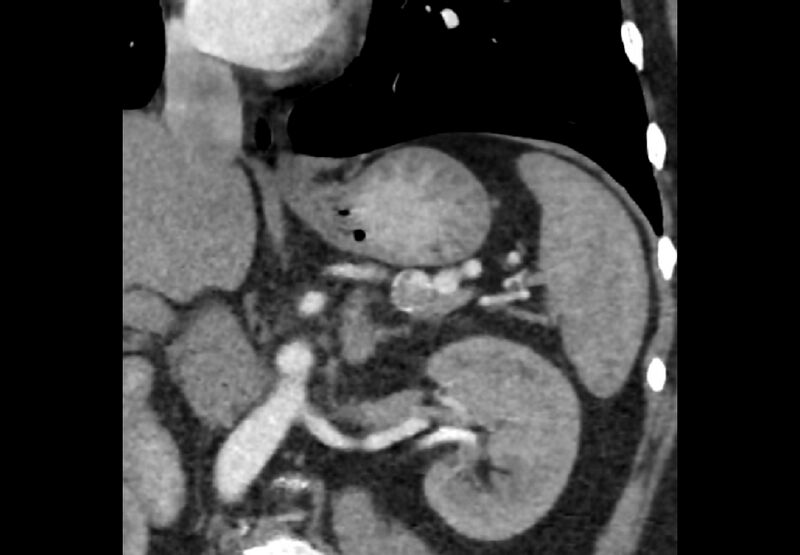 File:Bilateral urolithiasis with incidentally detected splenic artery aneurysm and left inferior vena cava (Radiopaedia 44467-48127 Ob. Cor. C+ Art. 16).jpg