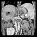 Biliary necrosis - liver transplant (Radiopaedia 21876-21846 C 27).jpg