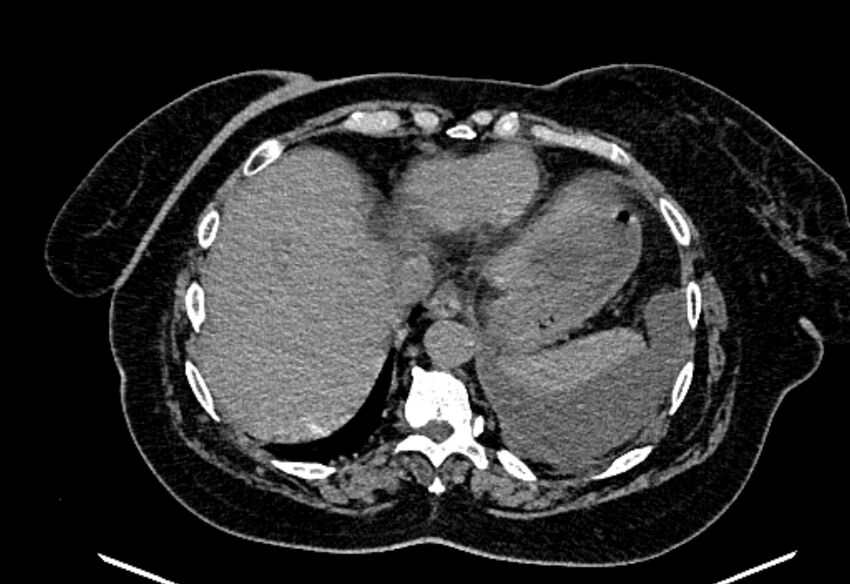 Biliary pancreatitis (Radiopaedia 72289-82823 Axial non-contrast 45).jpg
