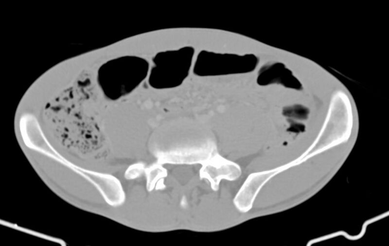File:Blunt injury to the small bowel (Radiopaedia 74953-85987 Axial Wide 65).jpg