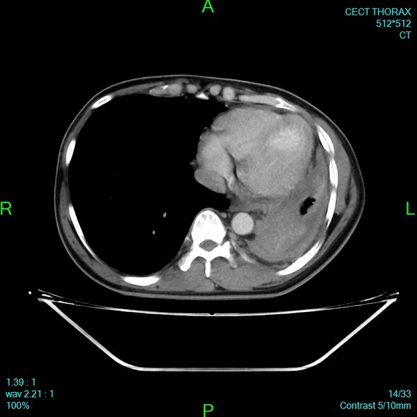 File:Bone metastases from lung carcinoma (Radiopaedia 54703-60937 Axial C+ delayed 14).jpg
