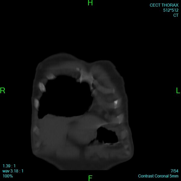 File:Bone metastases from lung carcinoma (Radiopaedia 54703-60937 Coronal bone window 7).jpg