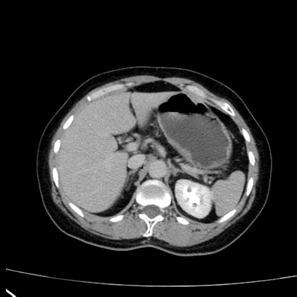 File:Bosniak renal cyst - type I (Radiopaedia 27479-27675 D 6).jpg