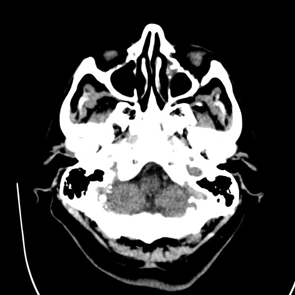 File:Brain Pantopaque remnants (Radiopaedia 78403-91048 Axial non-contrast 22).jpg