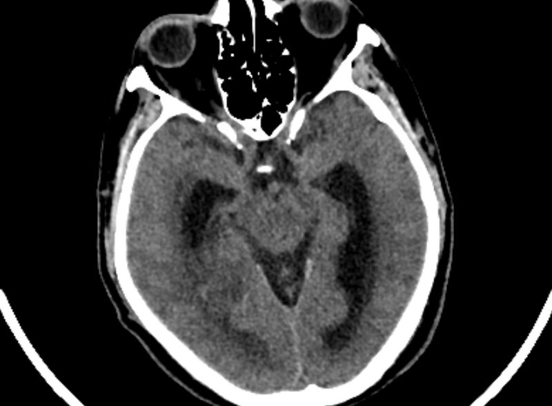 File:Brain abscess complicated by intraventricular rupture and ventriculitis (Radiopaedia 82434-96575 Axial non-contrast 19).jpg