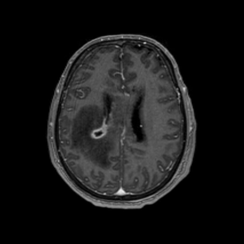 Brain abscess complicated by intraventricular rupture and ventriculitis (Radiopaedia 82434-96577 Axial T1 C+ 45).jpg