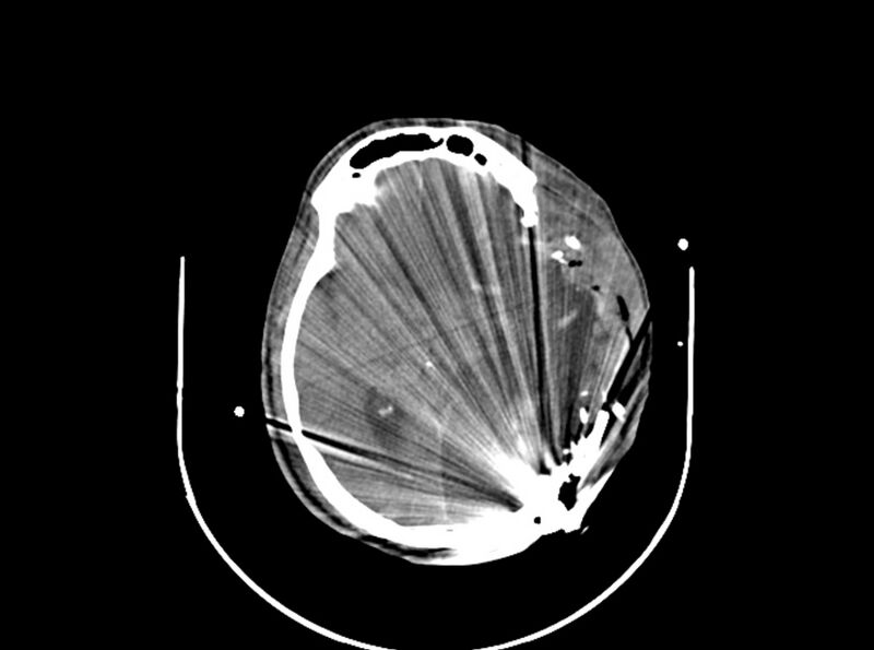 File:Brain injury by firearm projectile (Radiopaedia 82068-96087 B 103).jpg