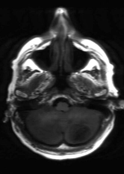File:Brain metastases from squamocellular lung cancer (Radiopaedia 56515-63222 Axial T1 6).jpg